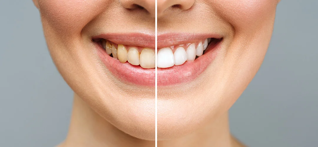 Crowns and bridges in lucknow, Best dentures in lucknow, Best maxillofacial surgeon in lucknow, Best dentist in Lucknow,  dentist in Lucknow